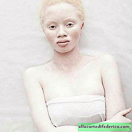 What do albinos of different races look like?