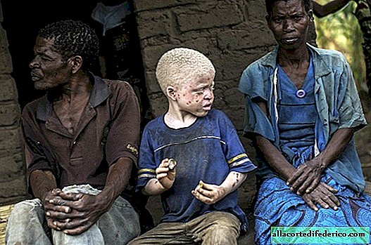 A terrible reality: in Africa, albino people are killed to make amulets of them